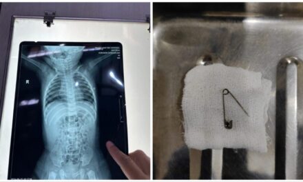 घशा मध्ये अडकलेली सेफ्टी पिन काढण्यात वालावलकर रुग्णालयाच्या डॉक्टरांना यश