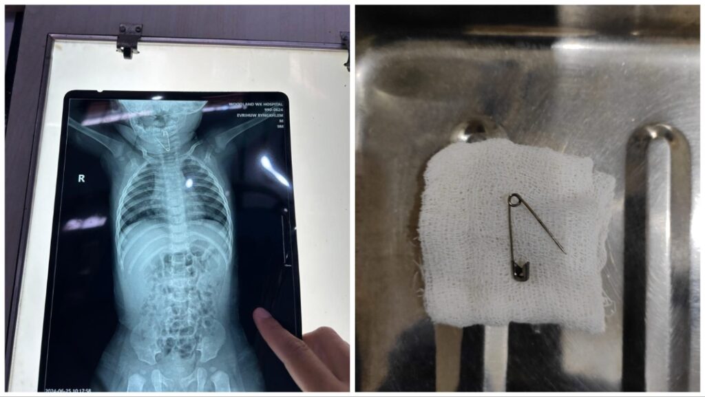 घशा मध्ये अडकलेली सेफ्टी पिन काढण्यात वालावलकर रुग्णालयाच्या डॉक्टरांना यश